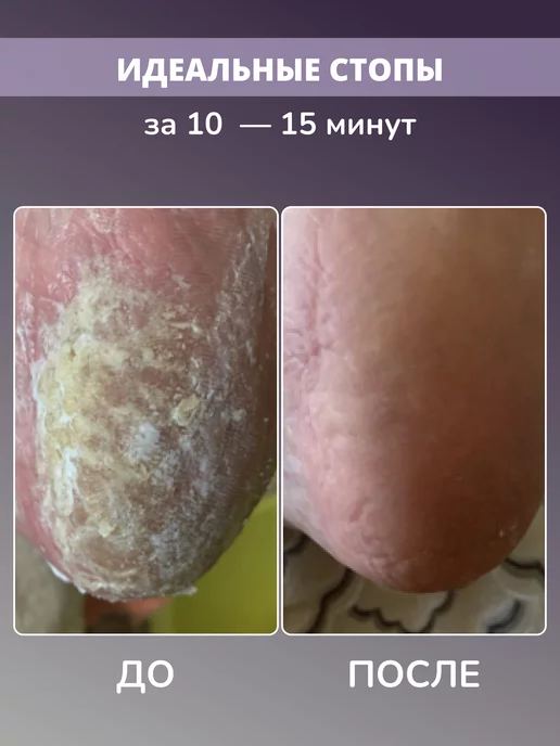 The VIRgin Beauty Кератолик для пяток от огрубевшей кожи и натоптышей, вариант, фото 3