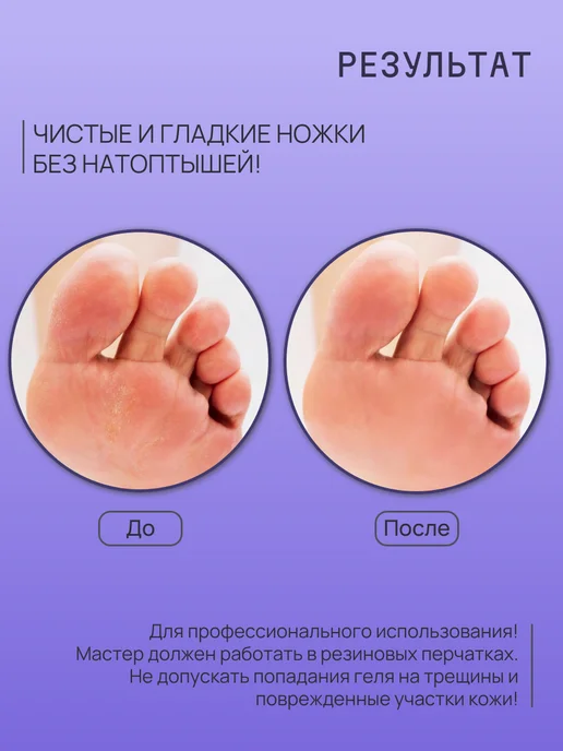Sagitta professional Кератолитик гель для удаления мозолей, вариант, фото 4