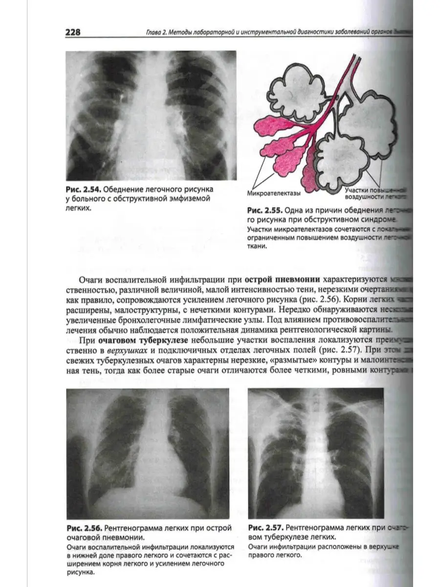 Мозаичная перфузия легких на КТ