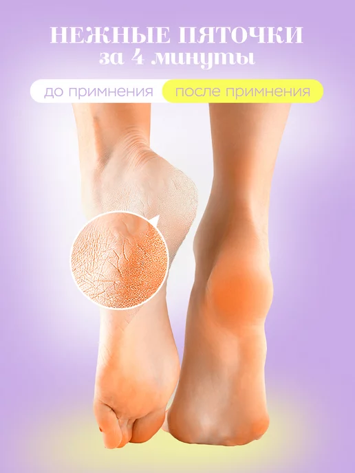 Нежные Пяточки Кератолитик средство для педикюра жидкое лезвие, вариант, фото 2